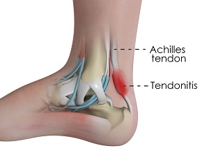 Achillles Tendinitis