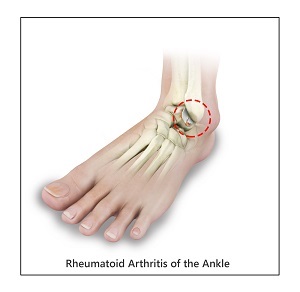 Ankle Rheumatoid Arthritis