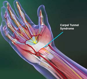 Endoscopic Carpal Tunnel Surgery