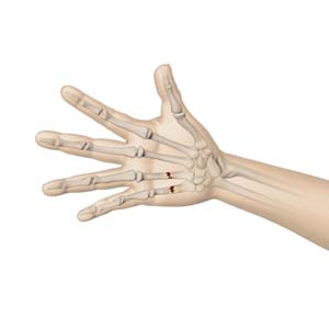 How Hand Fractures are Diagnosed and Treated