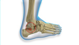 Heel Fractures