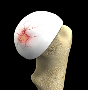 Hip cartilage Repair