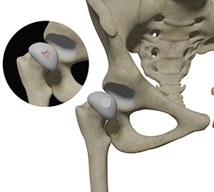 Hip Cartilage Restoration