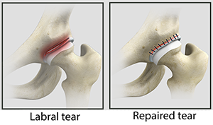 labrum labral torn tissue cartilage marsupi canguri soluzione chirurgia