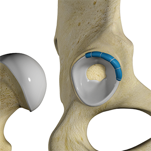 Hip Trauma Reconstruction