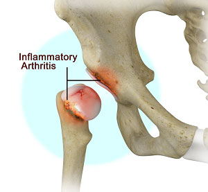 Inflammatory Arthritis of the Hip