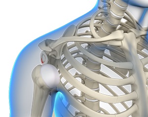 Multidirectional Instability of the Shoulder