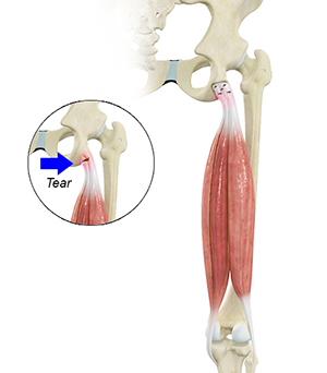 Proximal Hamstring Repair Milwaukee, Madison, WI