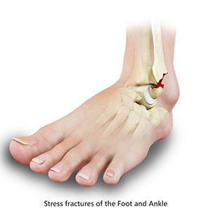 Stress Fractures of Foot & Ankle