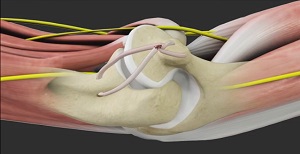 Ulnar Nerve Transposition Madison, WI