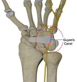 Ulnar Nerve Compression in Guyon's Canal