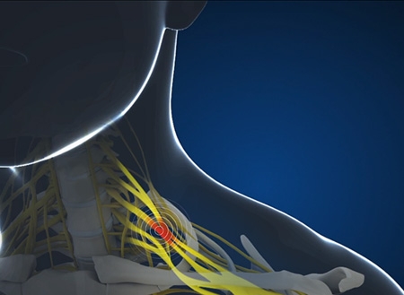 They Mystery of the Brachial Plexus