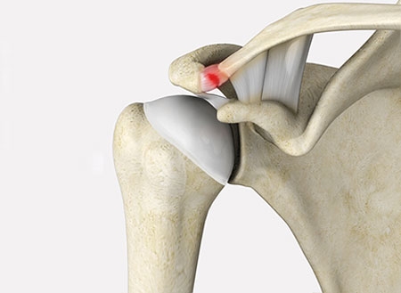 AC Joint Sprains