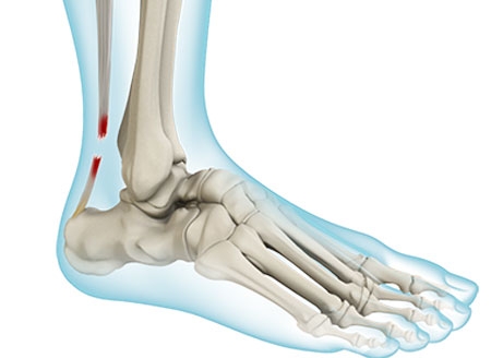 Achilles Tendon Ruptures