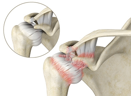 Adhesive Capsulitis