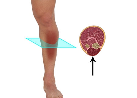 Compartment Syndrome  Orthopaedic Associates of Wisconsin