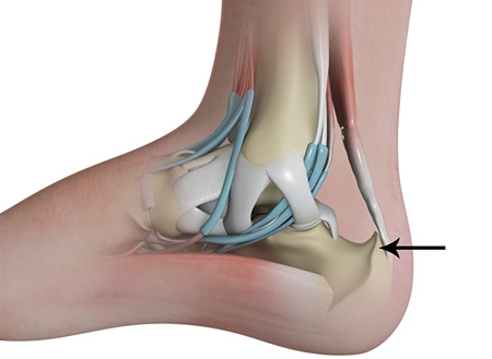 Haglund's Deformity