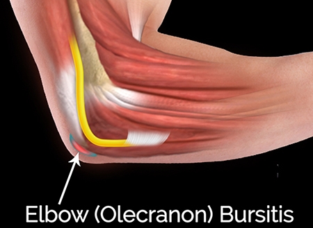 Olecranon Bursitis