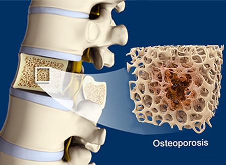 Osteoporosis