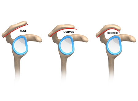 The Acromion Anomaly