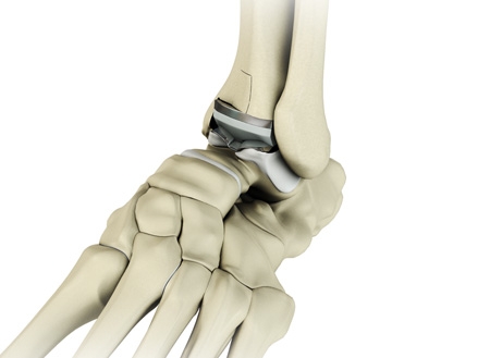 Total Ankle Replacement