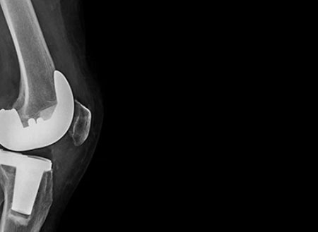 Total Joint Replacement Misconceptions
