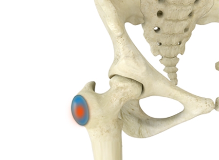 Trochanteric Bursitis