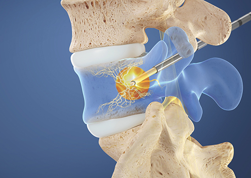 BVN Vertebra